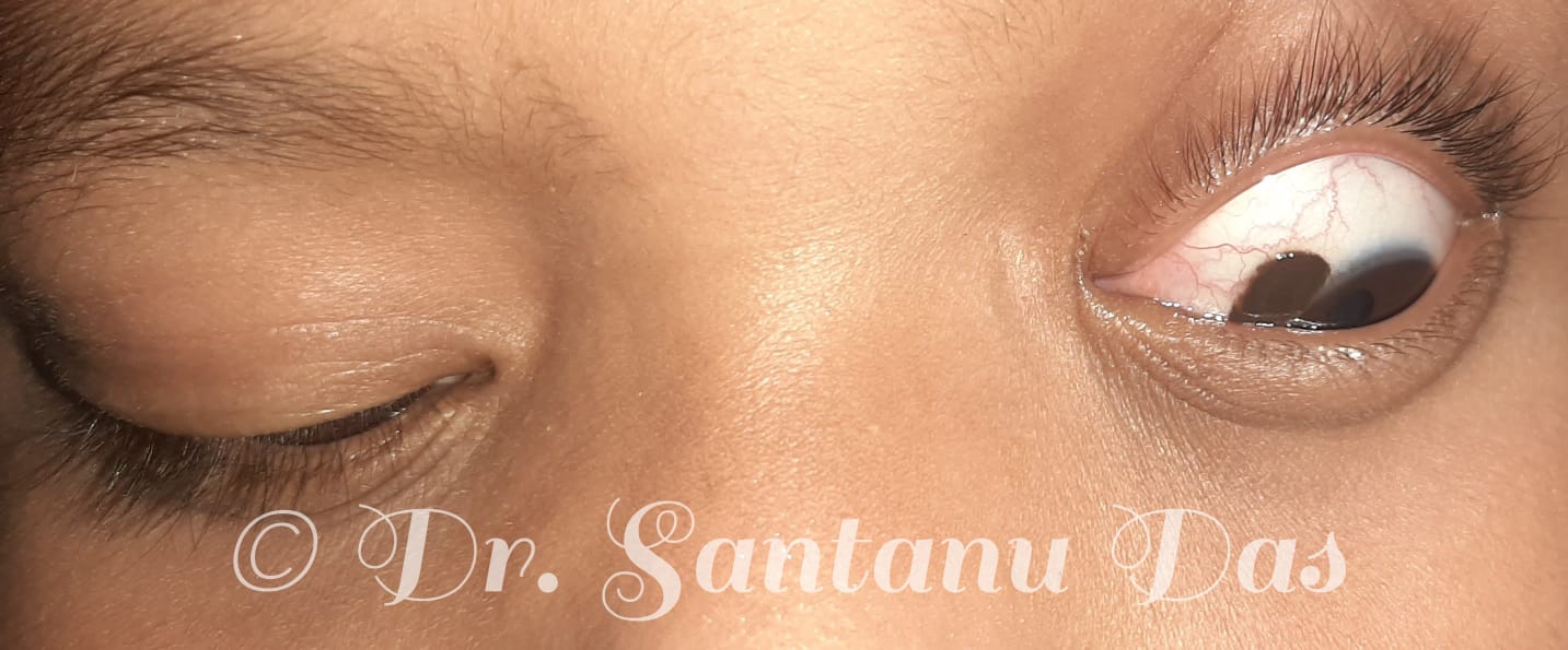 Left sided ocular surface naevus